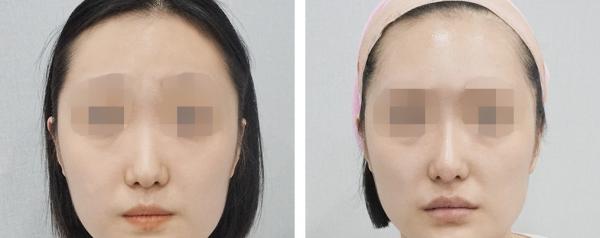 홍대점_이마필러+바비코
