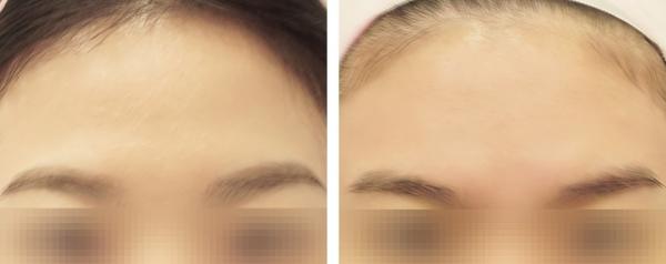 홍대점_이마필러+이마+미간보톡스